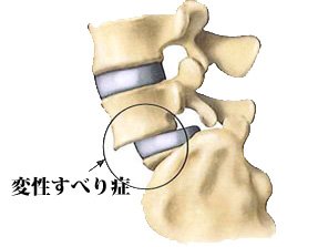 変性すべり症
