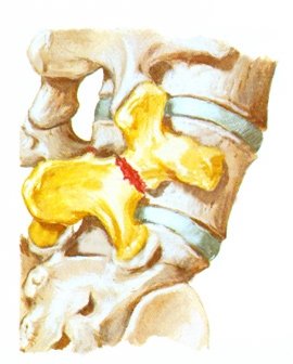 spondylolysis