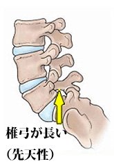 先天性 すべり症